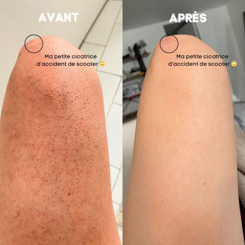 Éponge Sérénicia™ — La solution douce pour les jambes de fraise